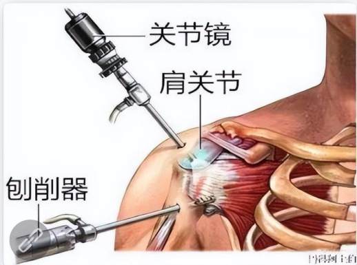 关节镜手术