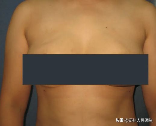 广东街头巨乳雕像(0.4肾结石需要碎石吗)